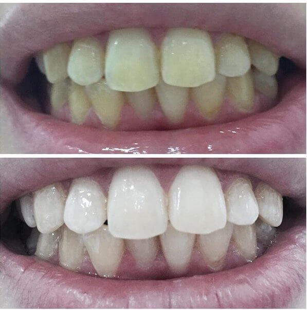 сильное отбеливание зубов до и после